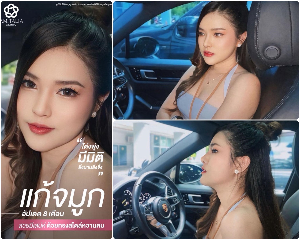 แก้จมูก #ลูกสาวอมิ #สายลักชูรี่