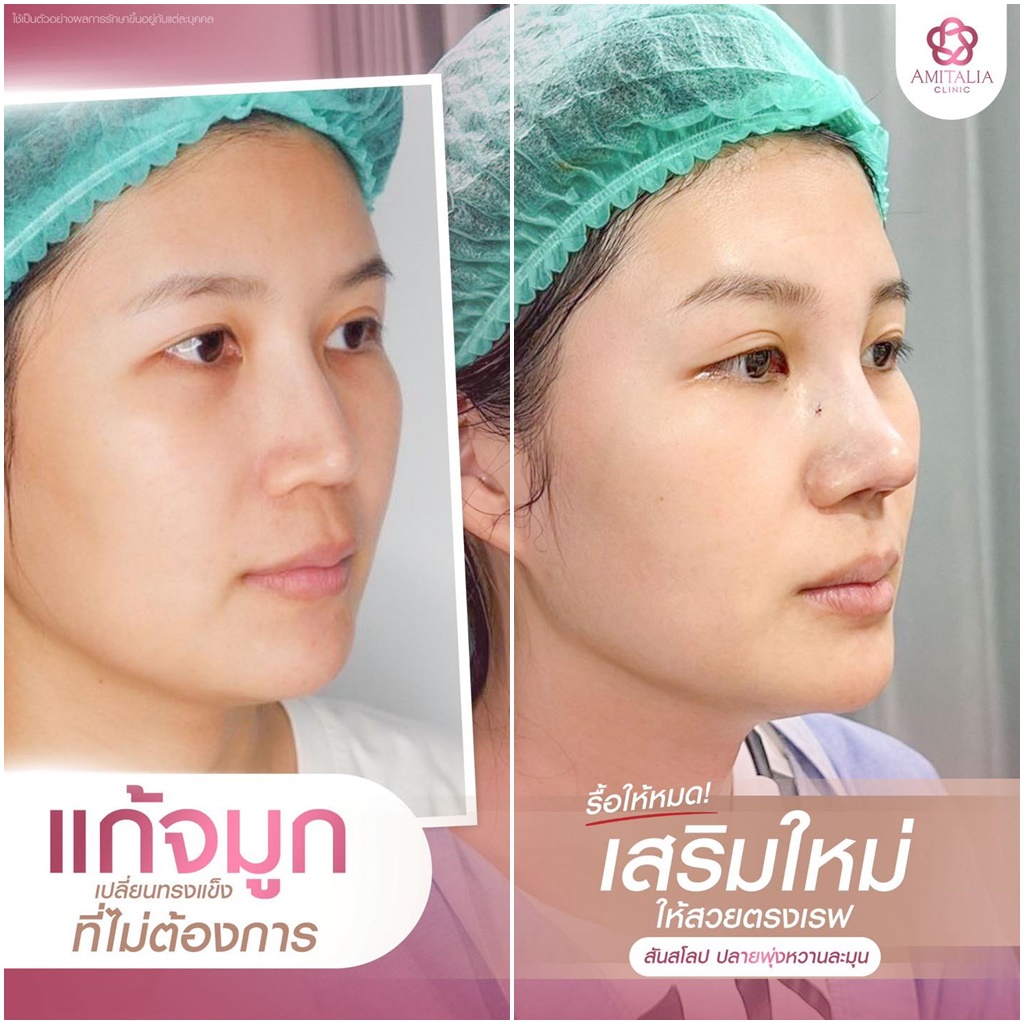 แก้จมูกหลังทำเสร็จทันที