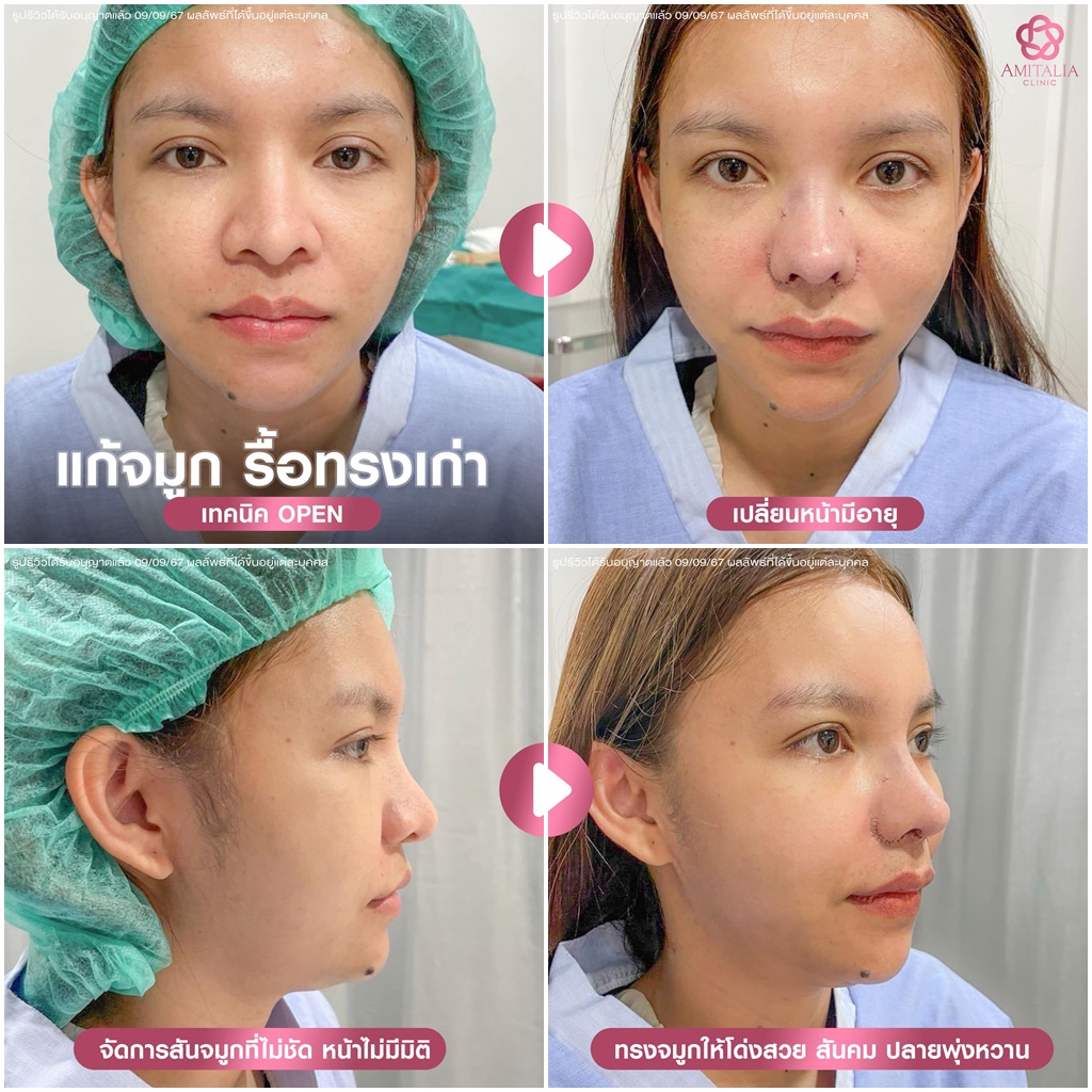 รีวิวแก้จมูกเเบบ ช็อตต่อช็อต