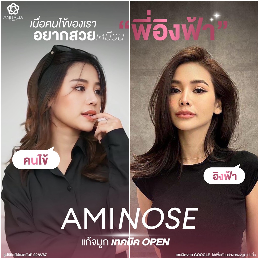 แก้จมูกเทคนิค OPEN