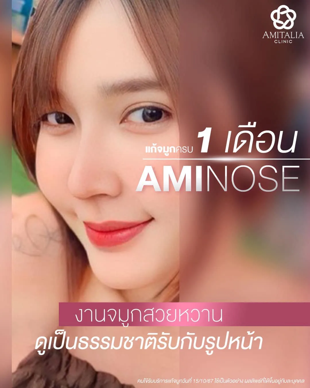 แก้จมูกครบ 1 เดือน ด้วยทรง AMINOSE