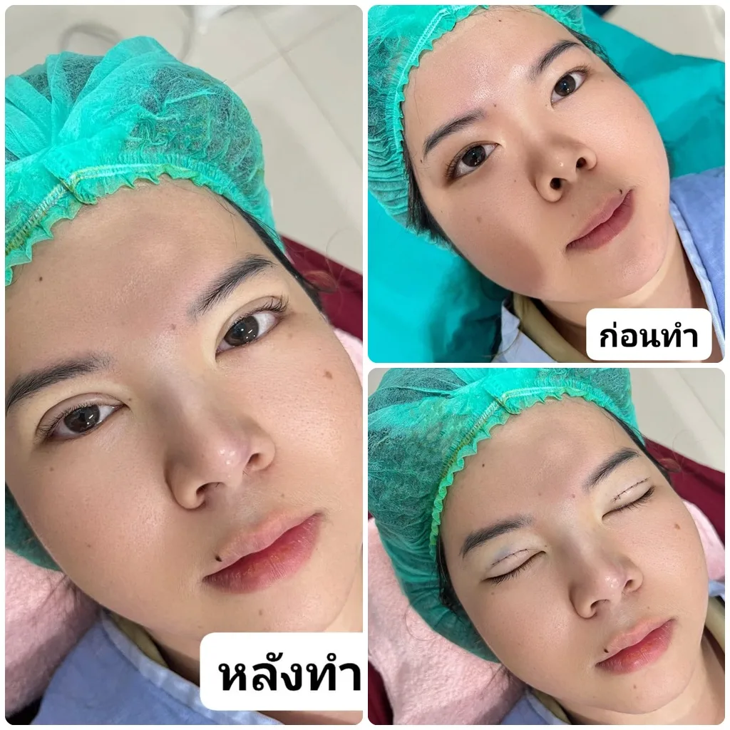 ศัลยกรรมตาสองชั้น เทคนิค Ami Eyes
