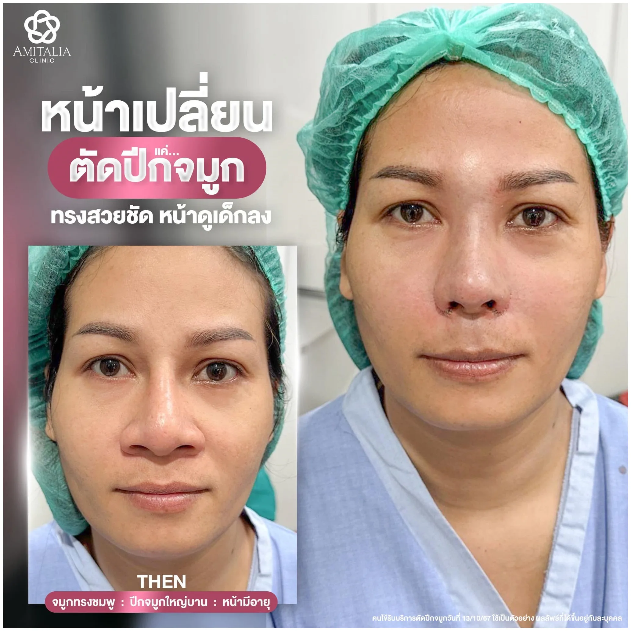 แค่ตัดปีกจมูก ก็ทำให้หน้าดูเด็กลง
