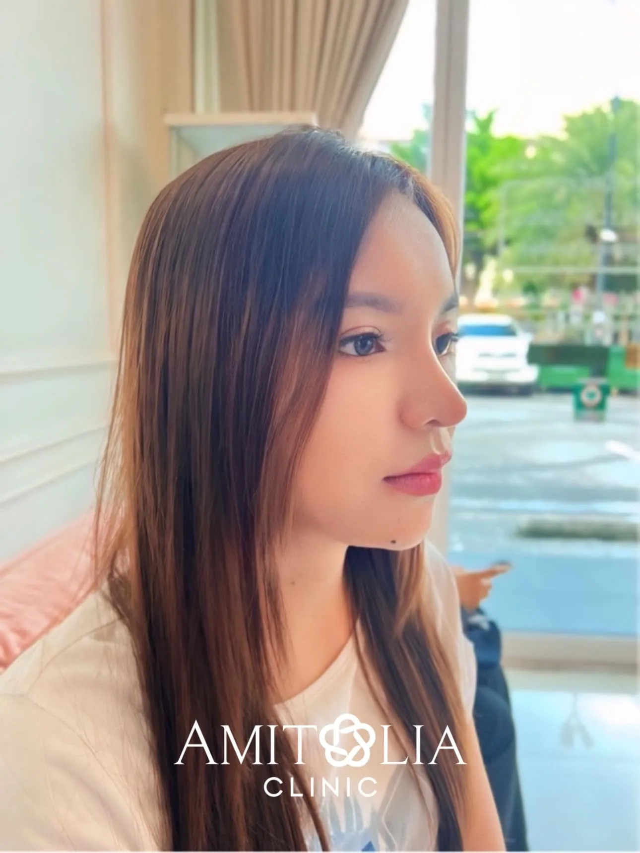 แก้จมูกเทคนิคโอเพ่น