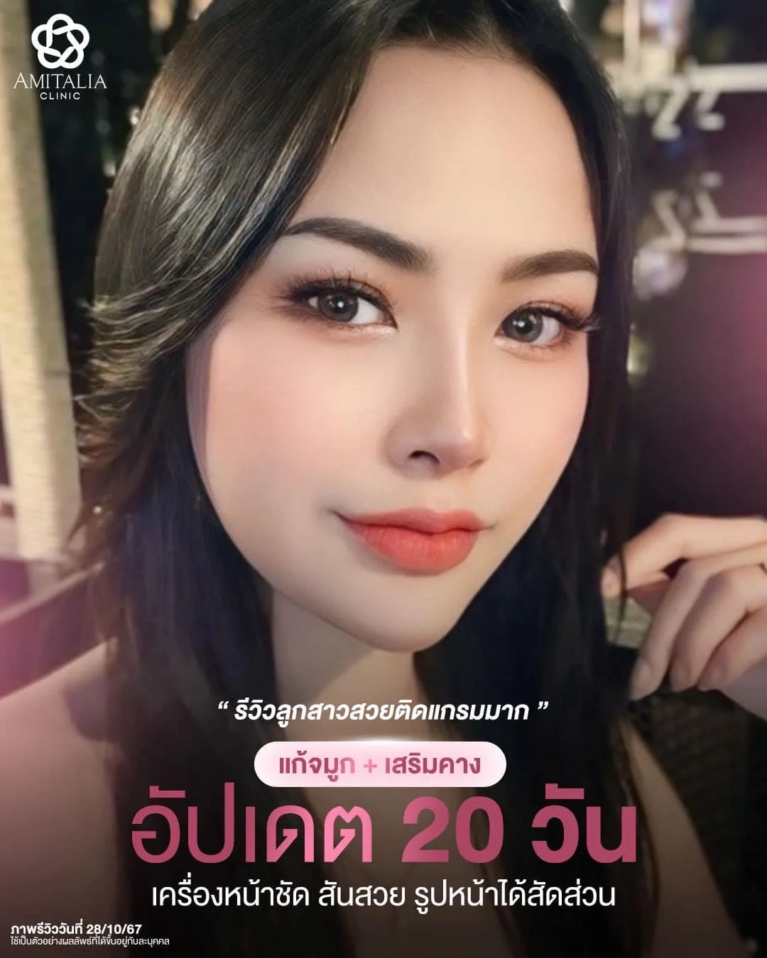อัปเดต 20 วันหลังทำจมูกและเสริมคาง
