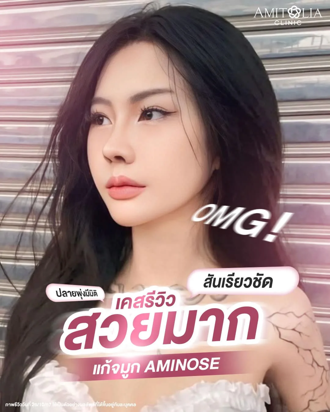 แก้จมูกแล้วเริ่ด คมเเละหวานในมุมเดียวกัน
