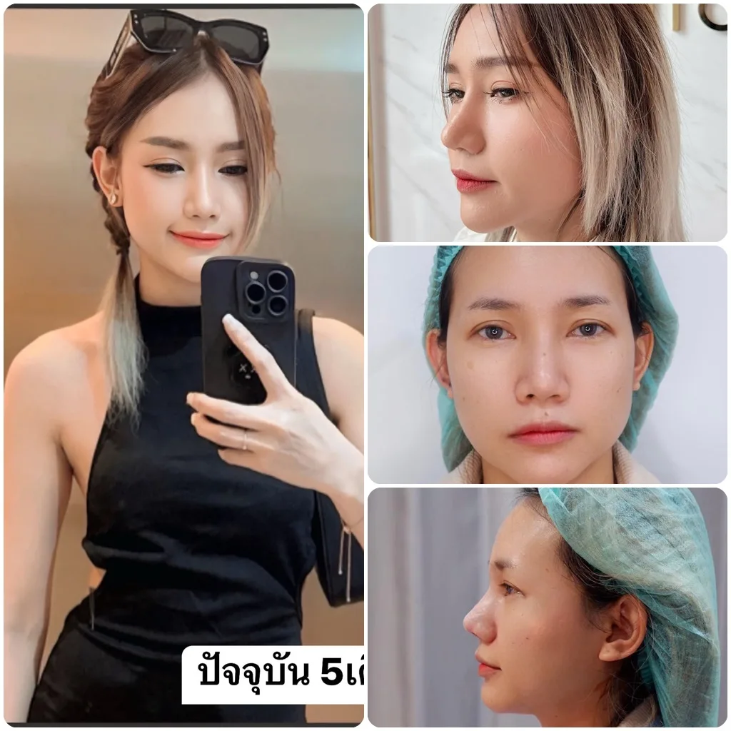 แก้จมูกครบ 5 เดือนแล้วค่าา!!