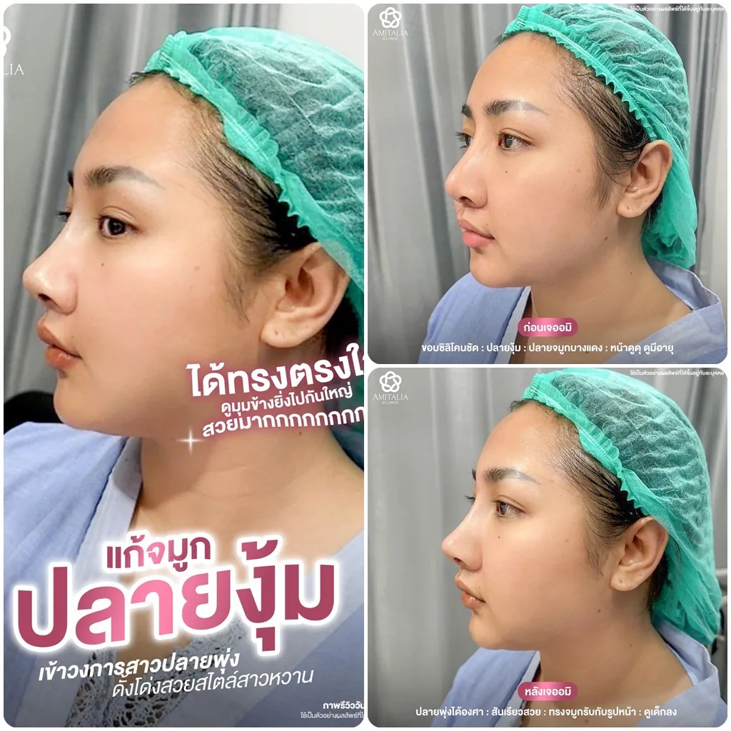 แก้จมูกครั้งสุดท้าย ได้ทรงตรงใจสักที