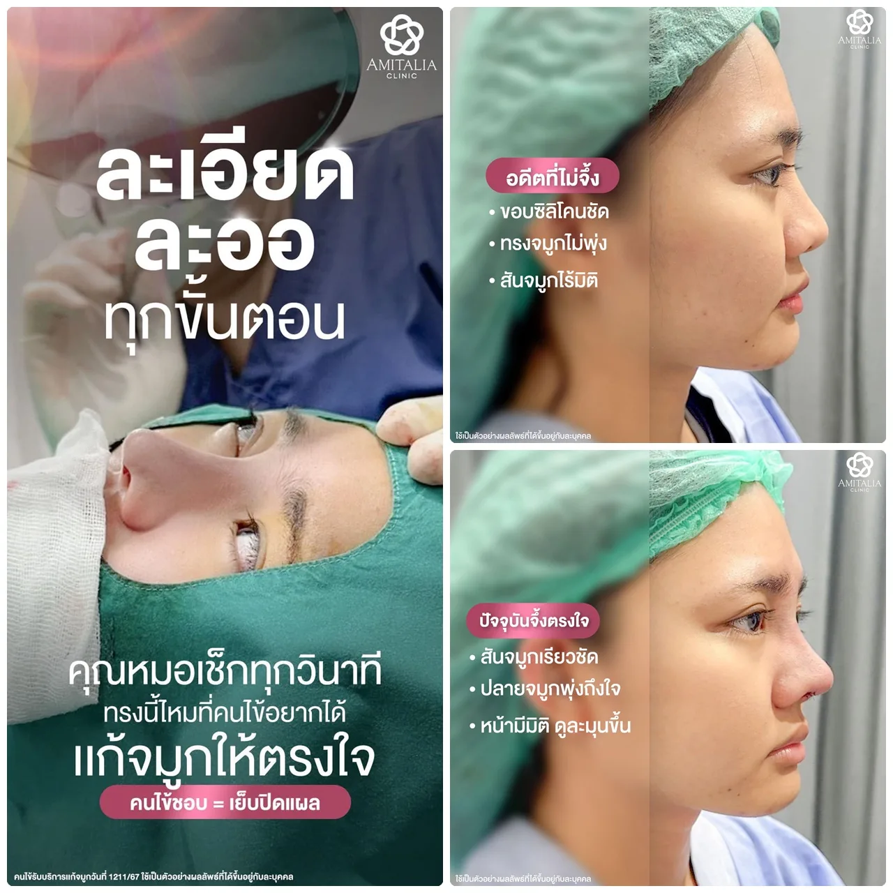 เคสนี้แก้ใหม่ รื้อทิ้งทั้งแท่ง คุณหมอเหลาซิลิโคนใหม่