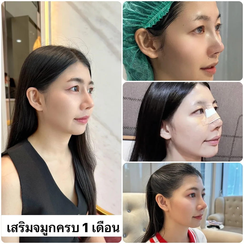 แก้จมูกครบ1เดือนค้า หน้าหว๊านหวาน