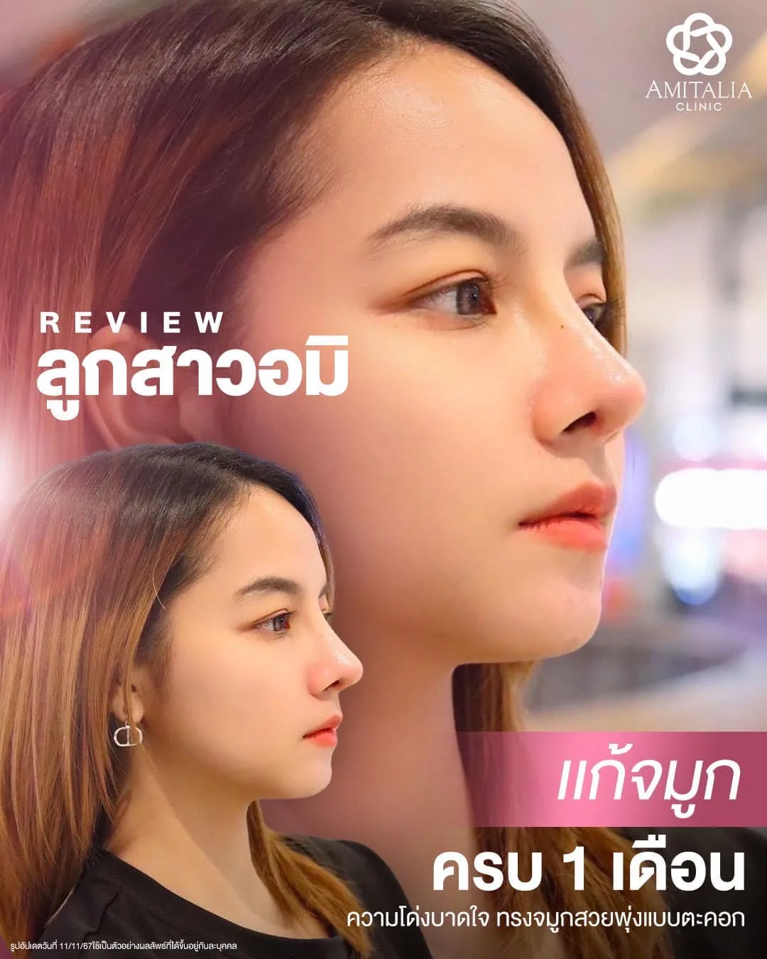 REVIEW เเก้จมูกครบ 1 เดือน…สวยจึ้ง