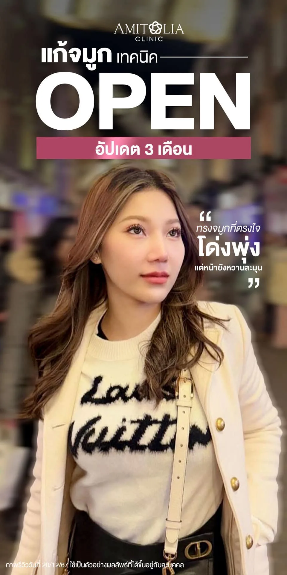 รีวิวแก้จมูกเทคนิค OPEN