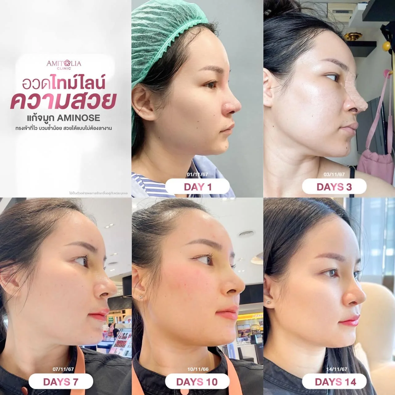 งานแก้ที่ไม่ใช่แค่แก้จมูก… แต่คืนความมั่นใจให้คนไข้ได้