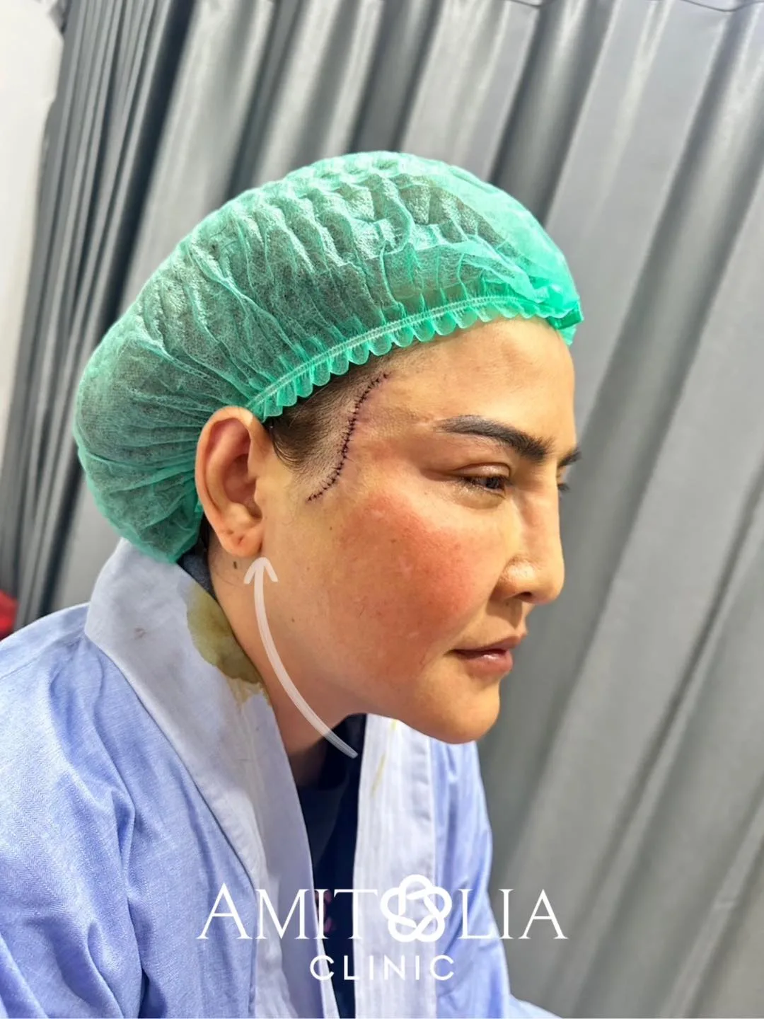 ดึงหน้ายกกระชับ กรอบหน้าชัด ใบหน้าดูอ่อนเยาว์