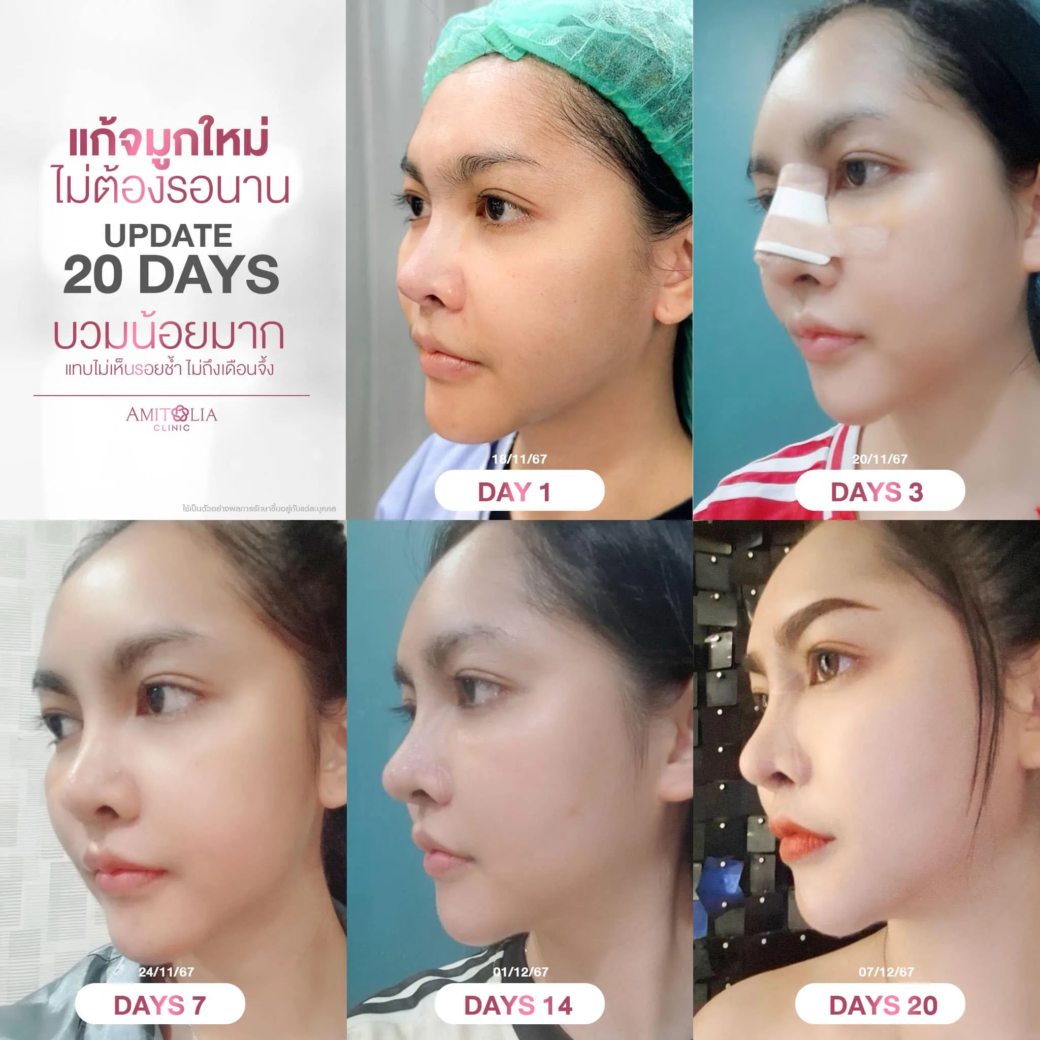 งานแก้จมูกไม่แพ้เสริมใหม่ สวยได้ไม่ต้องรอนาน