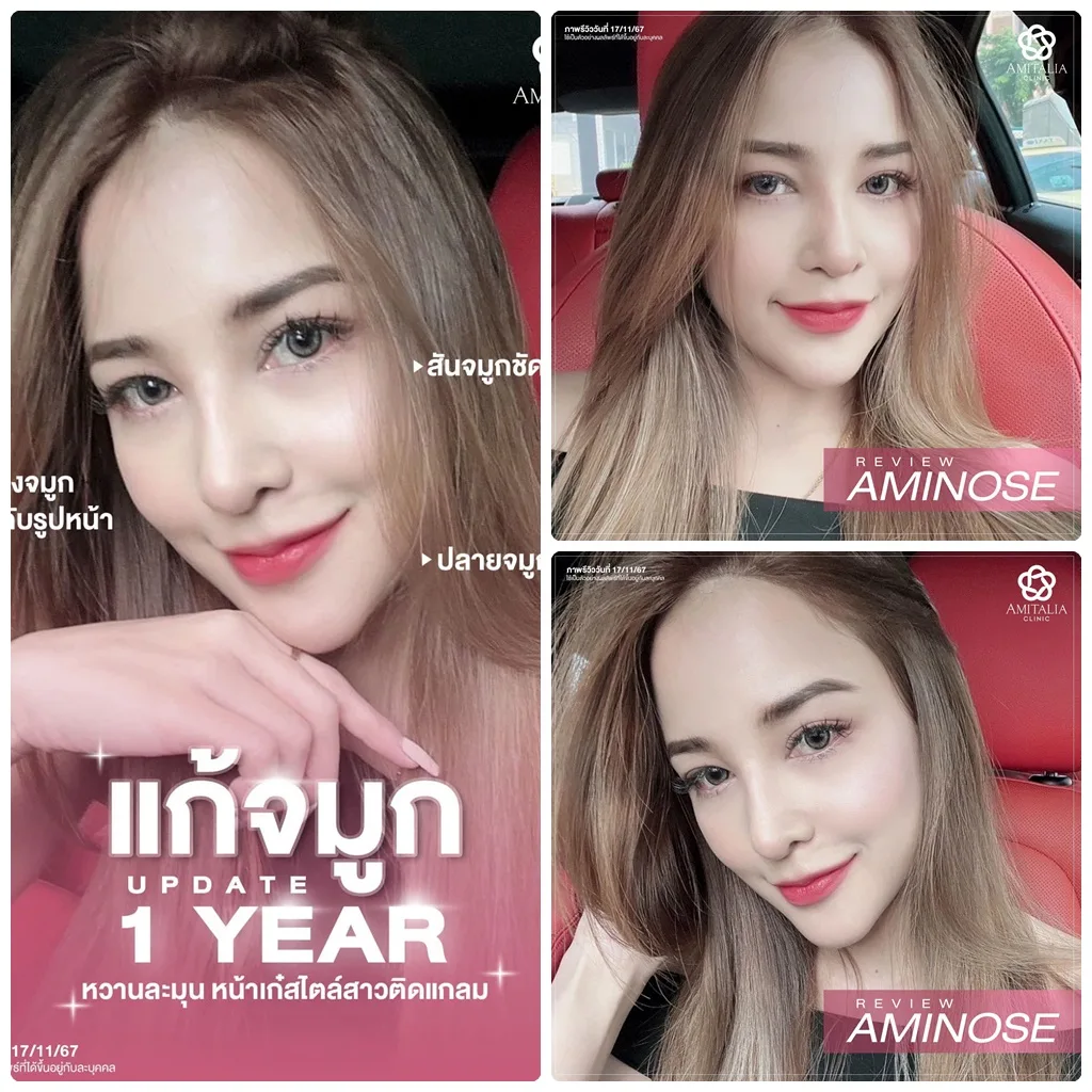 แก้จมูก 1 ปีผ่านไป…สวยขึ้นทุกมุม