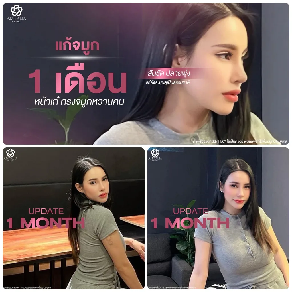 แก้จมูกครบ 1 เดือน เก๋ๆเชิดๆ เลยคร่าา