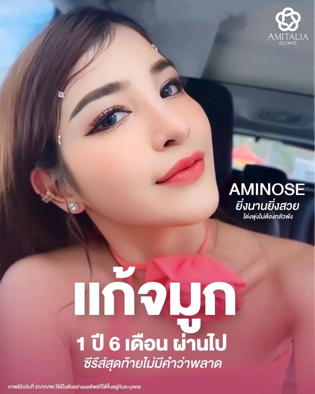 แก้จมูกกับ Aminose ต้องบอกว่า “ยิ่งนานยิ่งสวย”