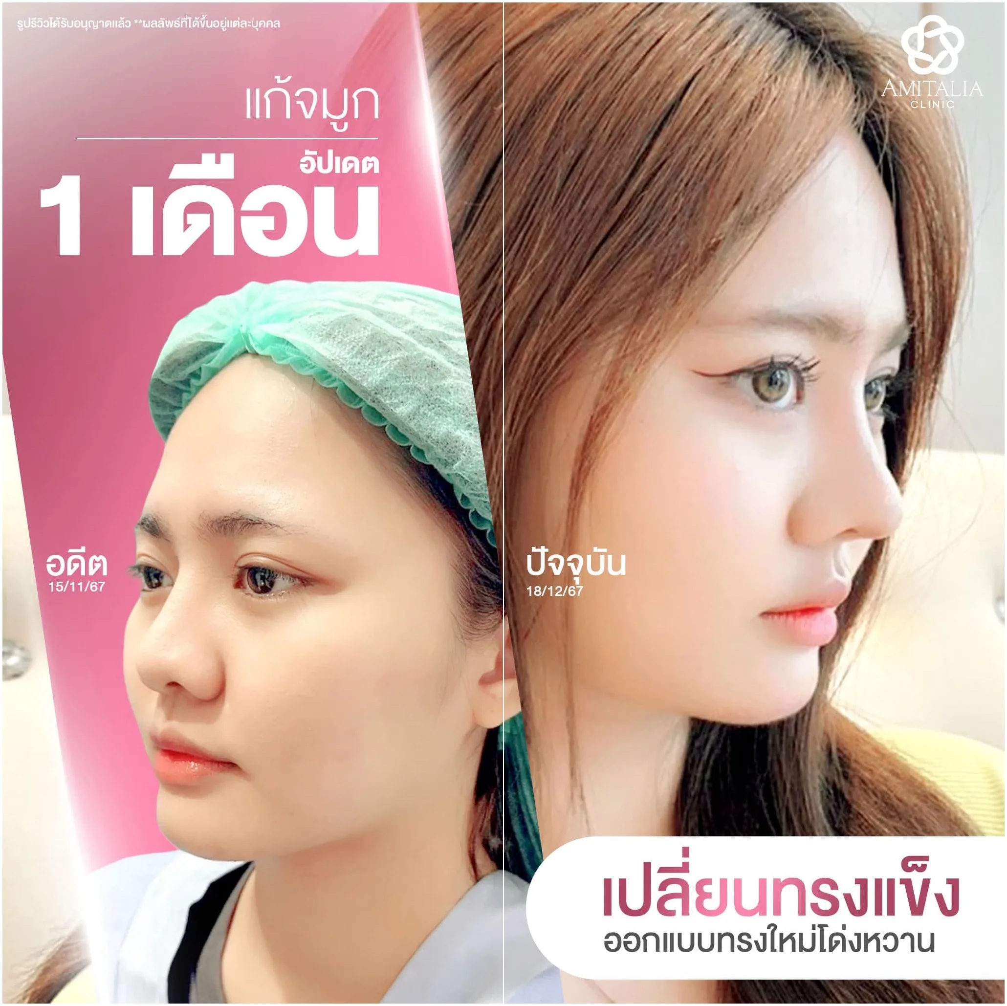 อัปเดต 1 เดือน แก้จมูกใหม่ด้วยเทคนิคเฉพาะ