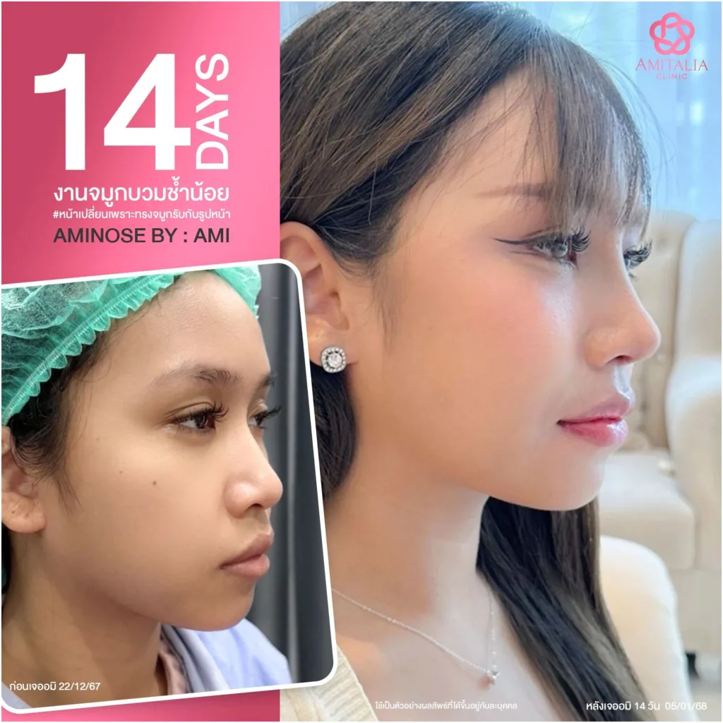 ทรงจมูก