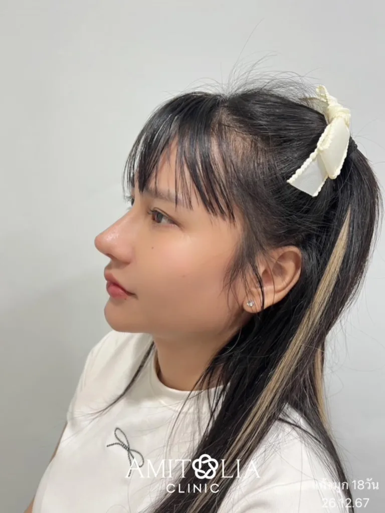 รีวิวแก้จมูก