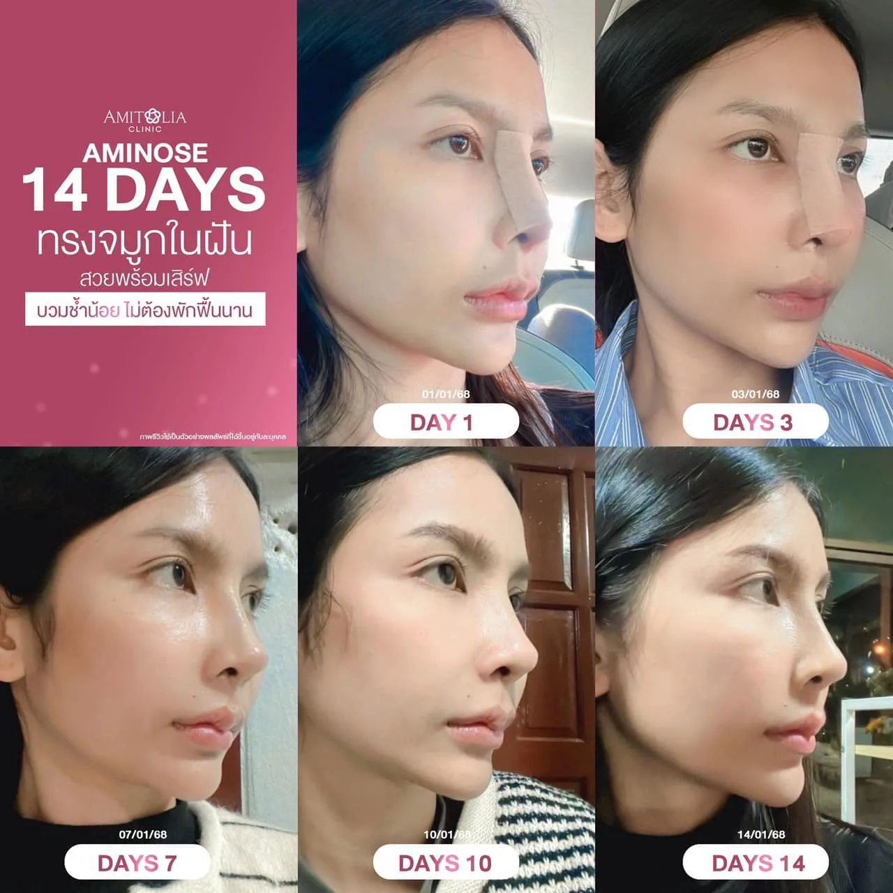 14 วัน สวยจึ้ง ใครจะเชื่อว่าทำจมูกมาแล้ว