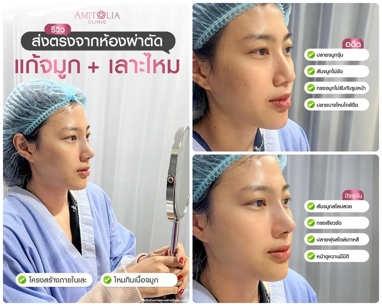 แก้เคสจมูกที่เคยร้อยไหม…รีบแก้ก่อนจะสายเกิน