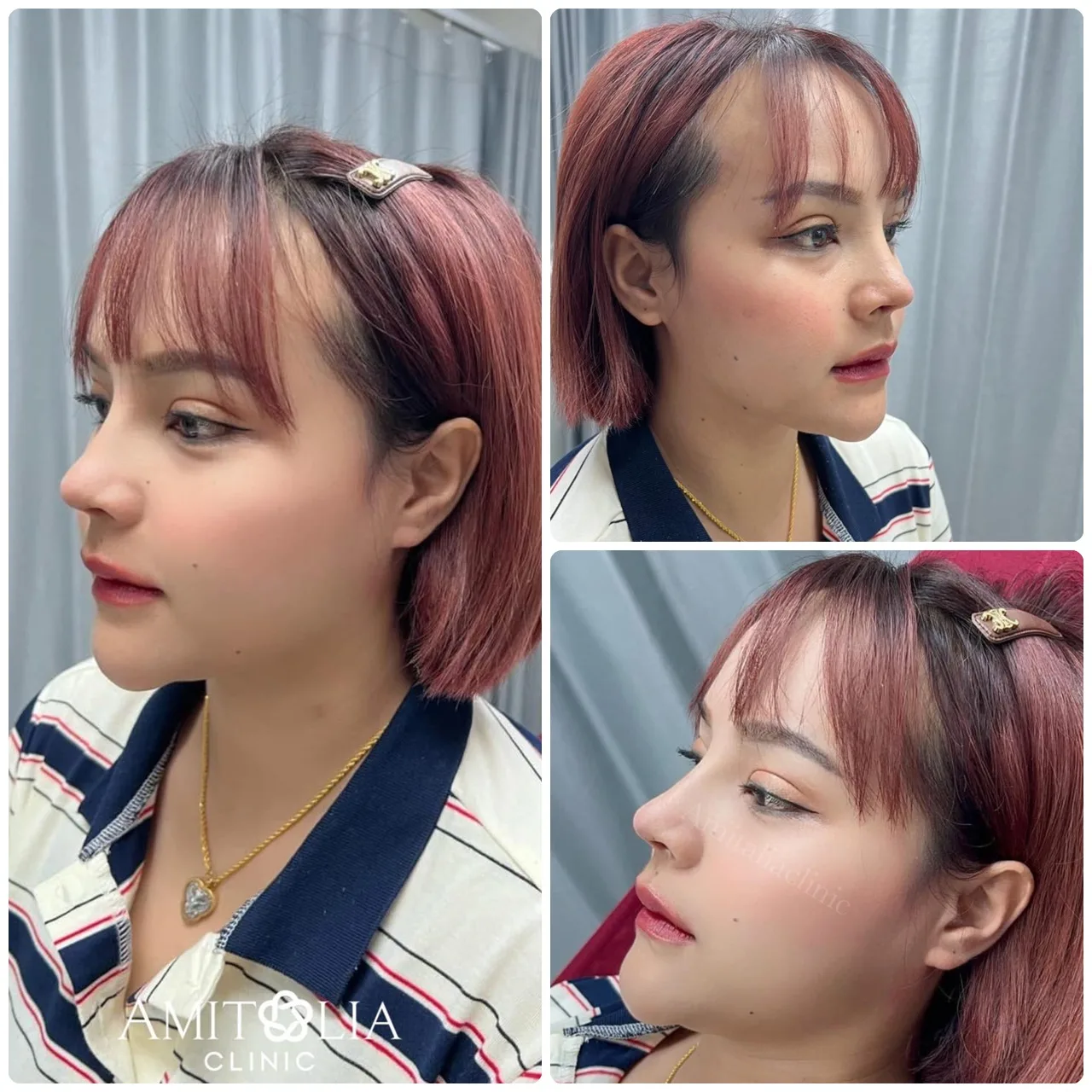 ทรงจมูกที่โด่งพุ่งสวยหวานในมุมเดียวกัน