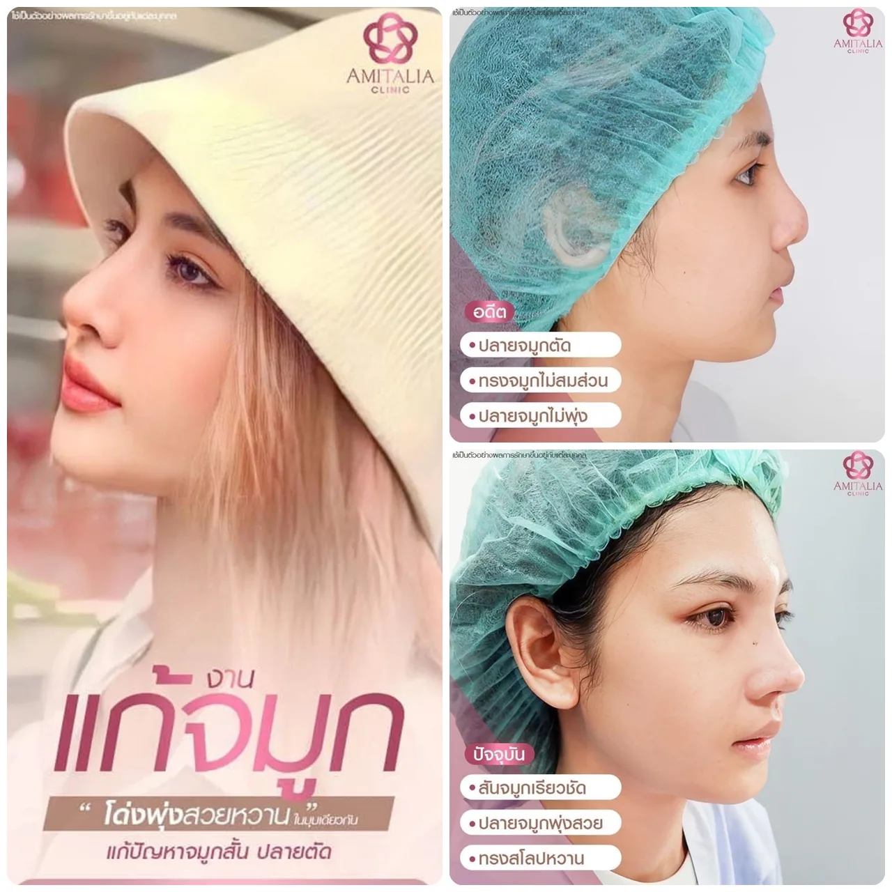 แก้จมูกทรงสวยละมุนมาก โด่งพุ่งสวยหวานในมุมเดียวกัน