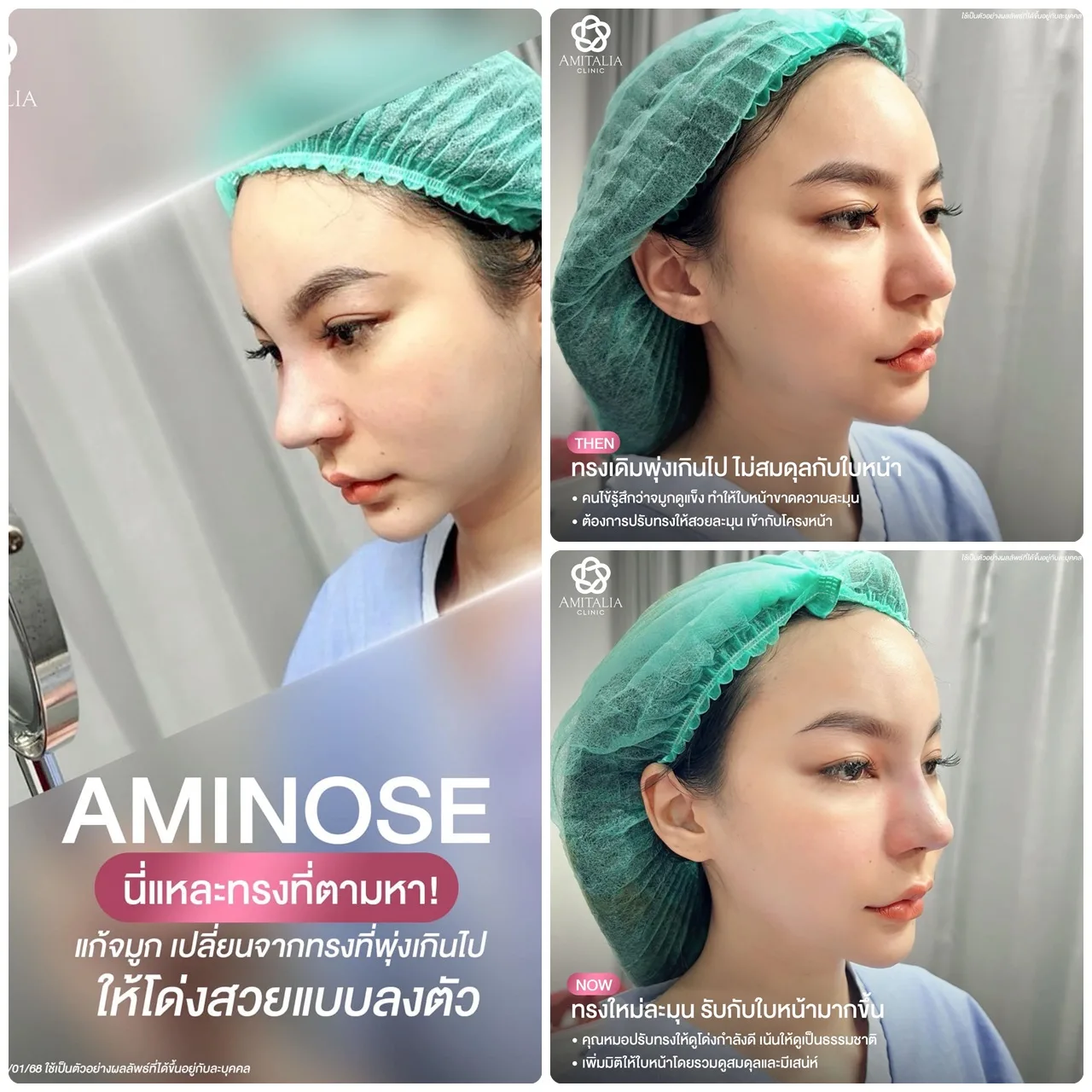จมูกพุ่งเกินปุยมุ้ย!! แก้จมูกให้ให้โด่งแบบพอดี