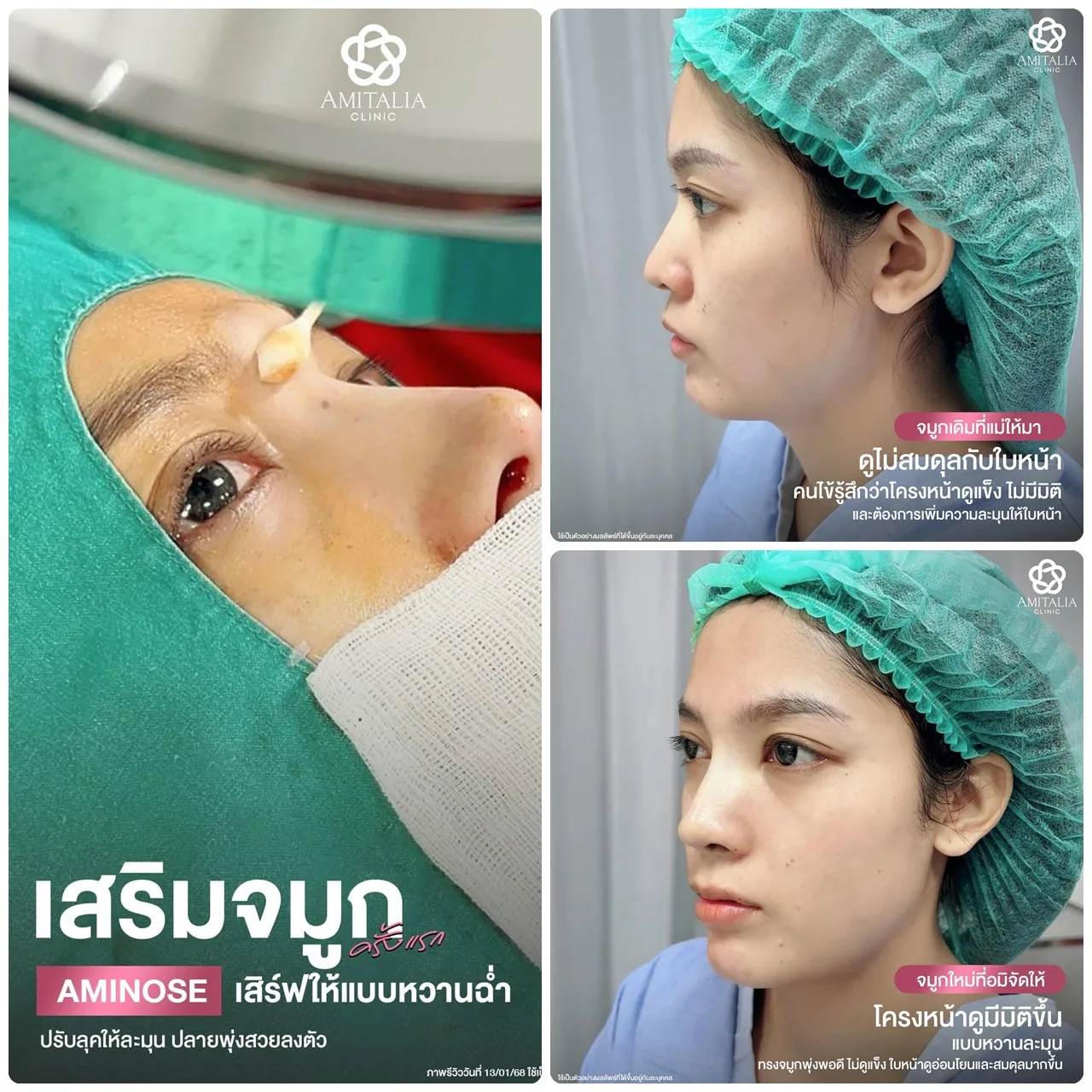 วันนี้เปลี่ยนไปแล้ว เสริมจมูกครั้งแรกไม่มีผิดหวัง
