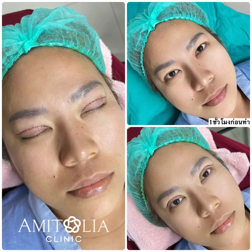 ตาสองชั้น