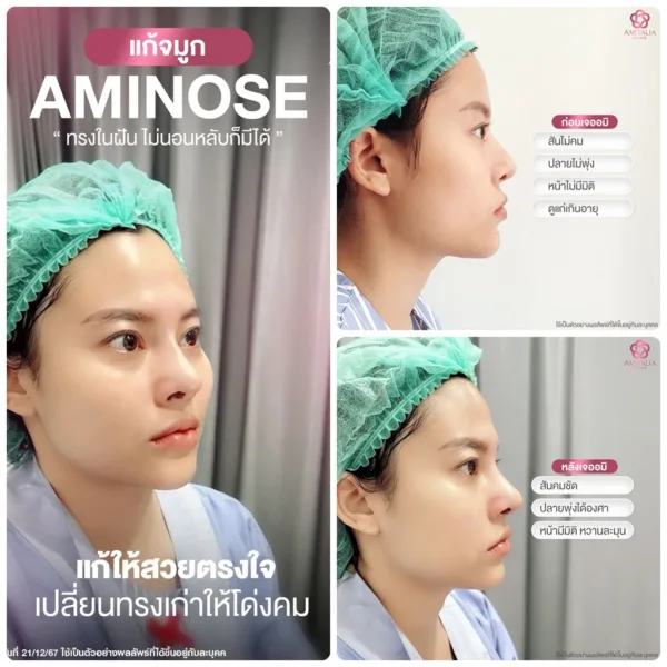 ทรงจมูก