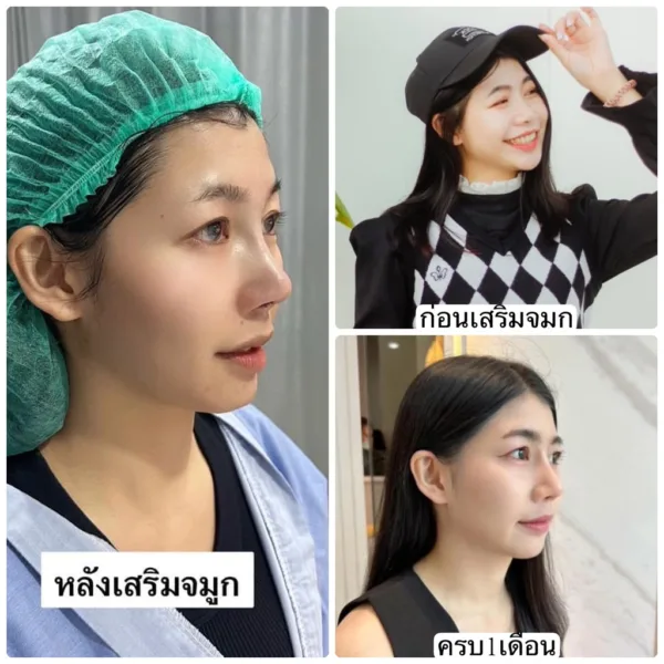 เสริมจมูก