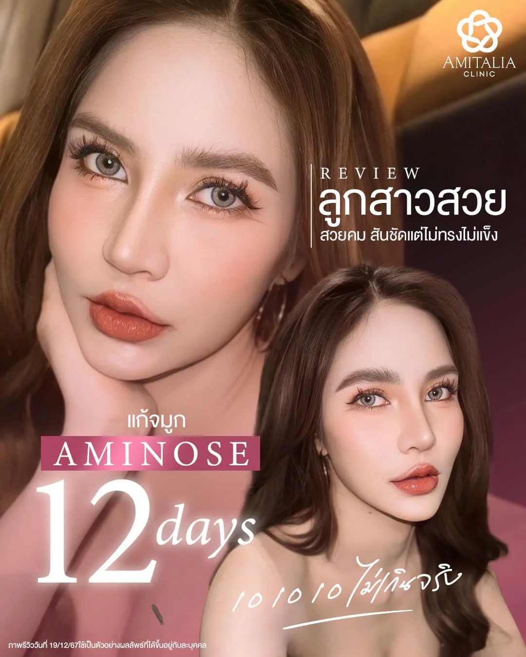12 วันหลังแก้จมูก AMINOSE