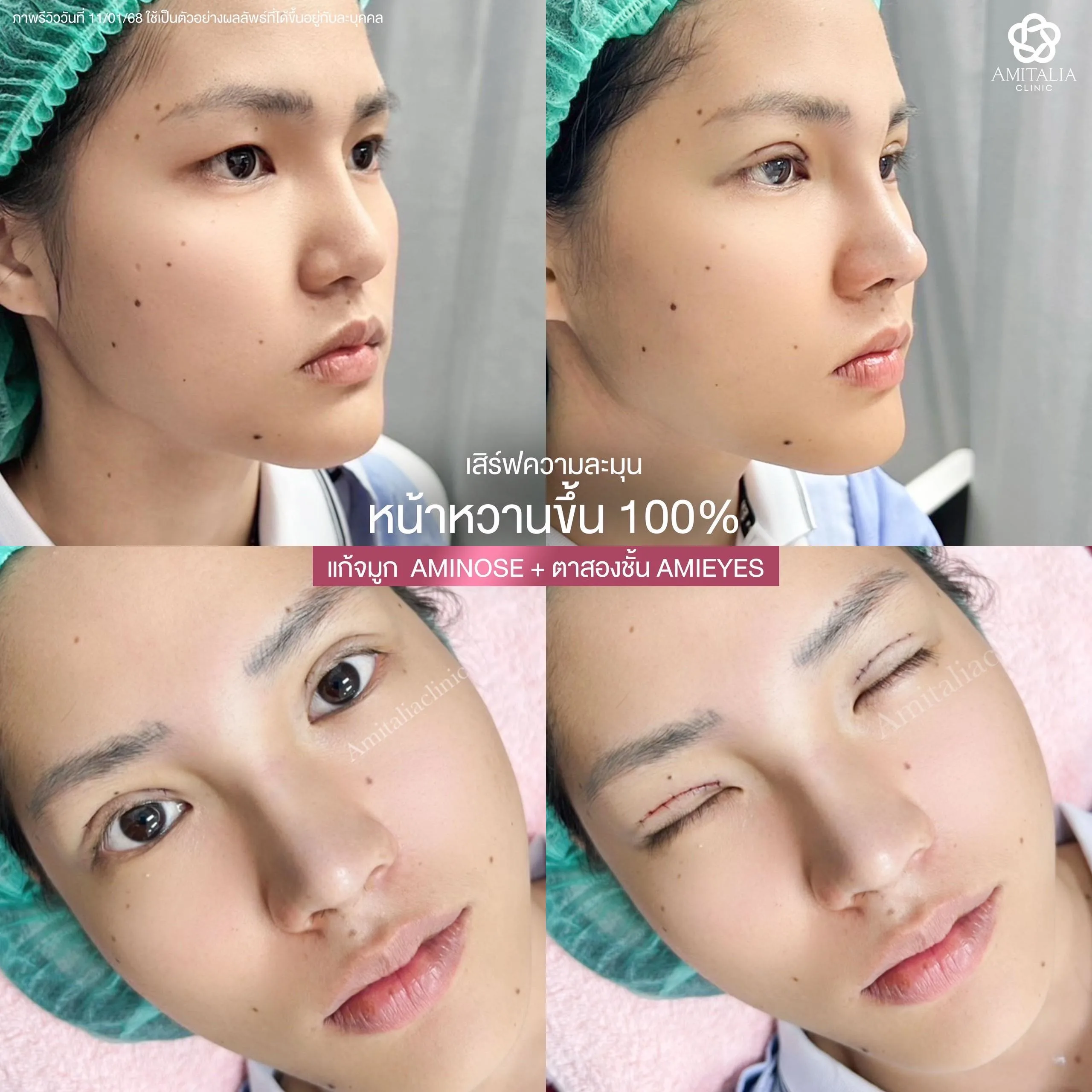 ศัลยกรรมจับคู่จมูก + ตา #ปังสุดๆค้า