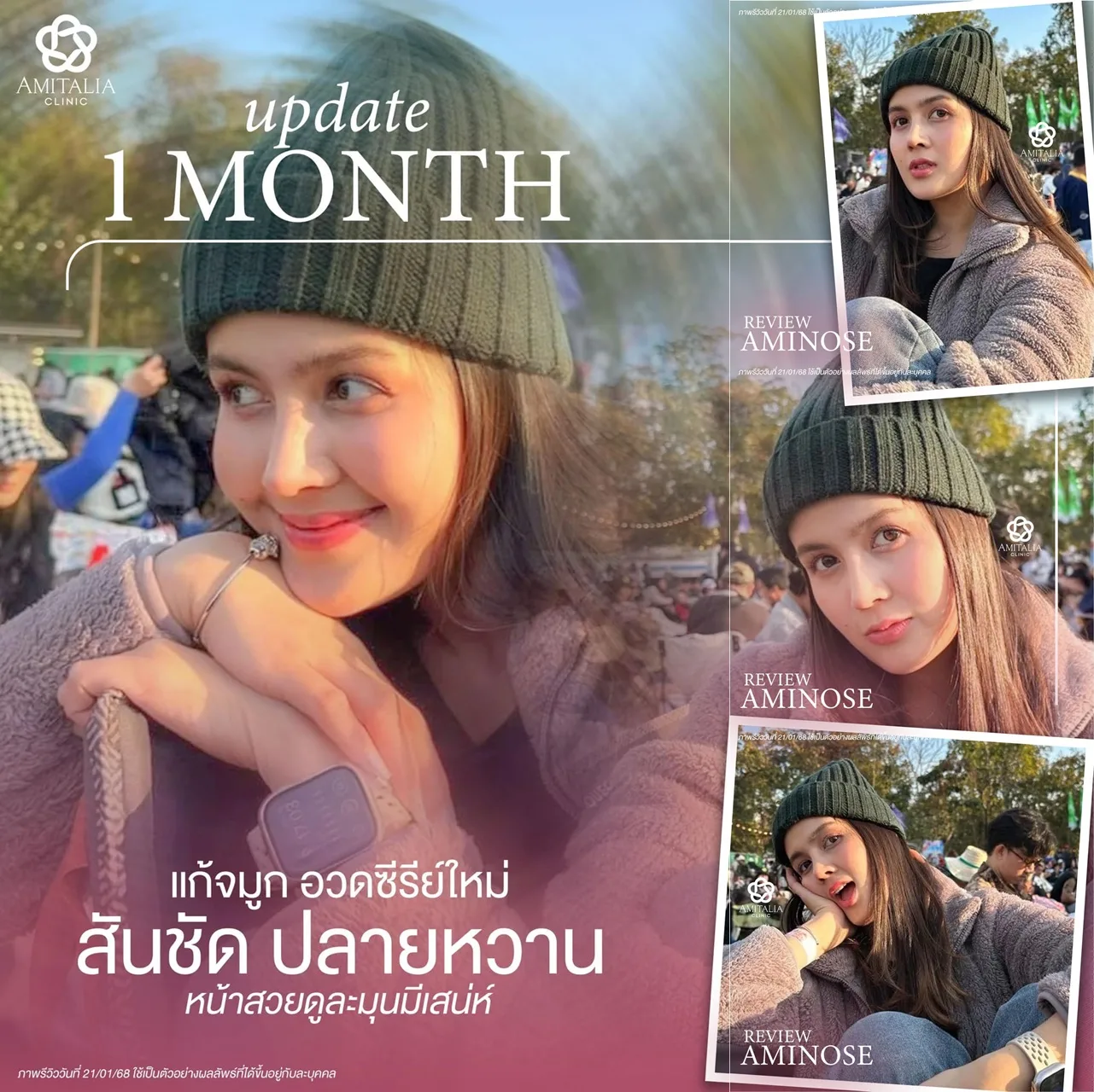 อัปเดตครบ 1 เดือนหลังแก้จมูก