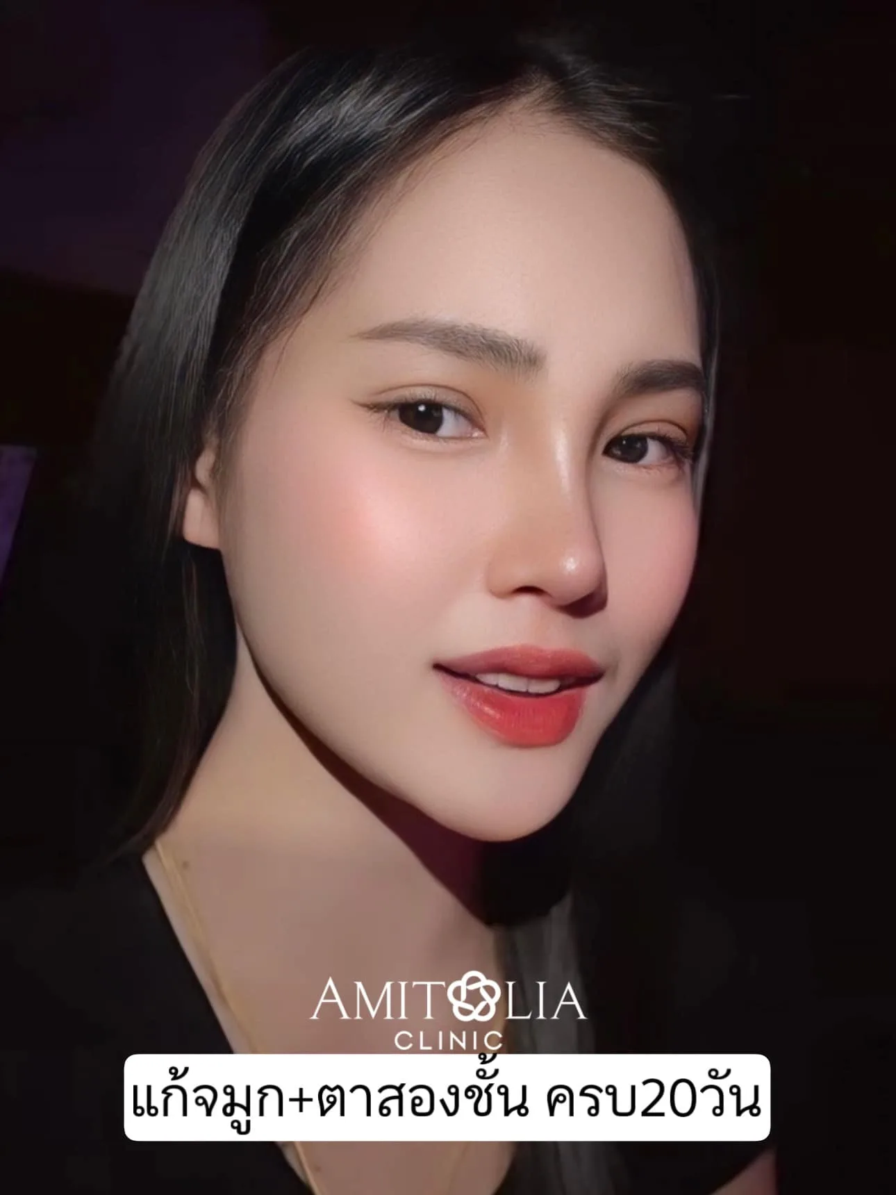 โปรจับคู่ศัลยกรรม จมูก+ตาสองชั้น