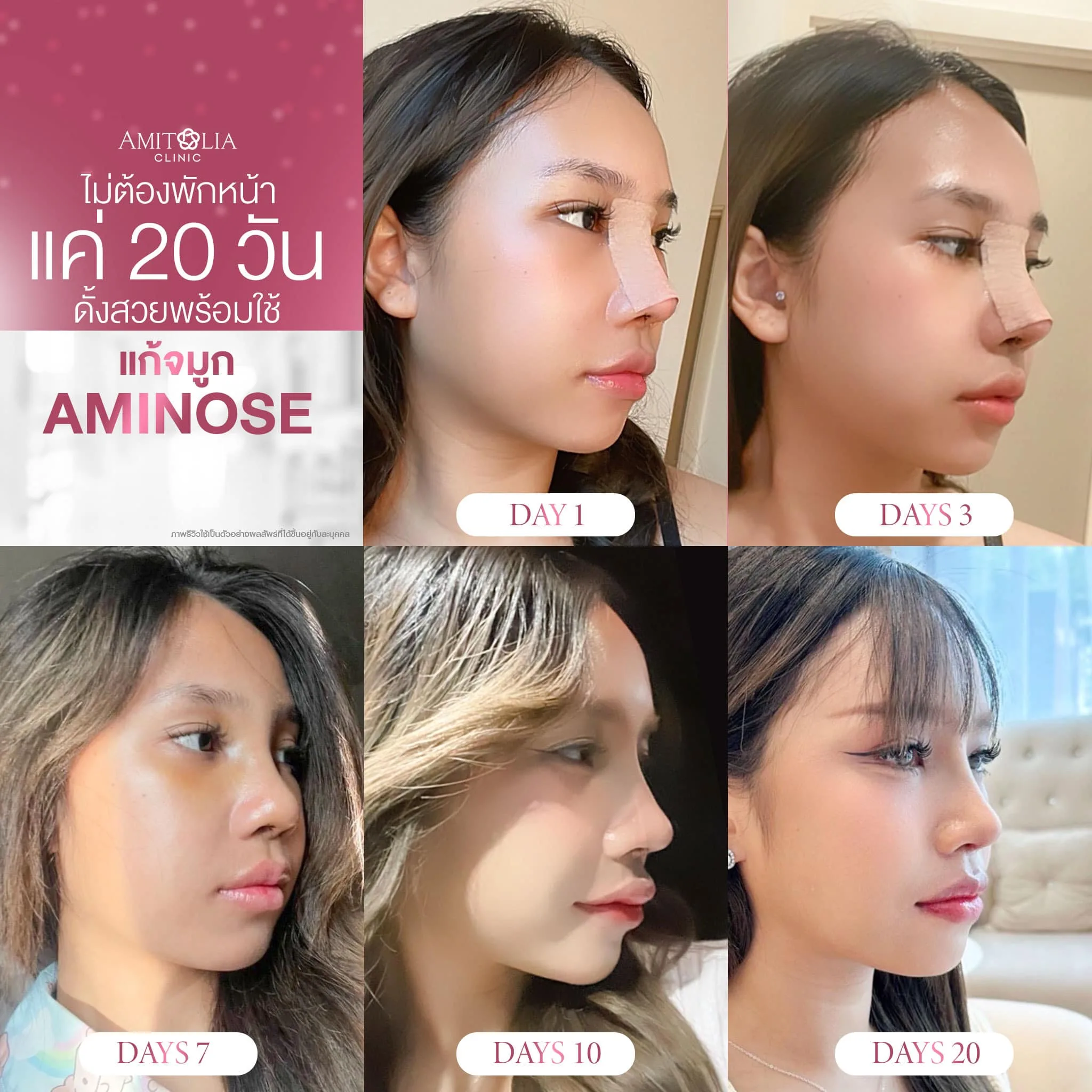 อยากเสริมจมูก แต่กลัวพักฟื้นนาน? ลองดูรีวิวนี้