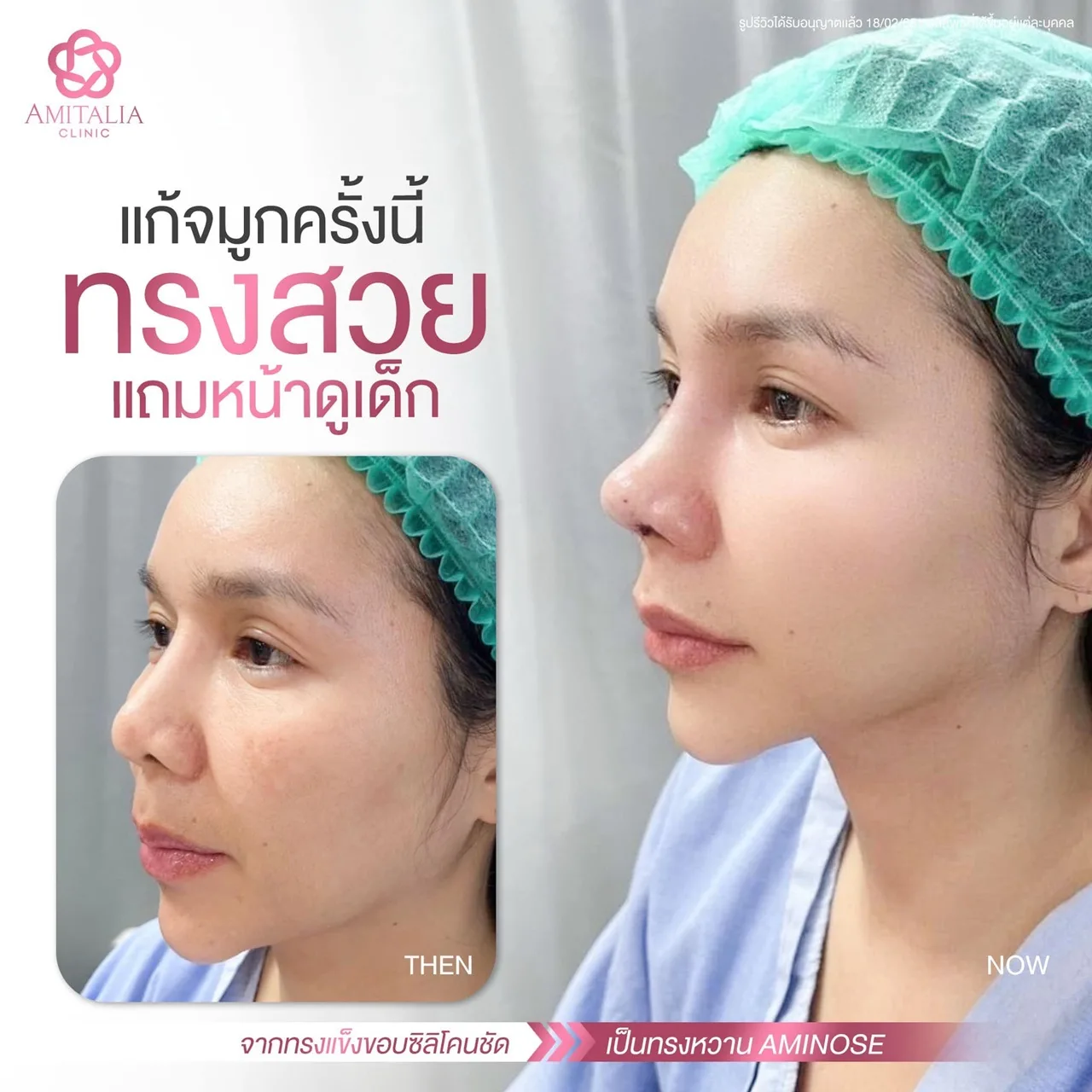 รีวิวลูกสาวสวยอีกเคส! แก้จมูกครั้งนี้คือจึ้งมาก