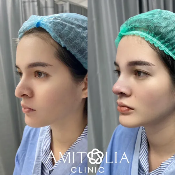 โปรแก้จมูก