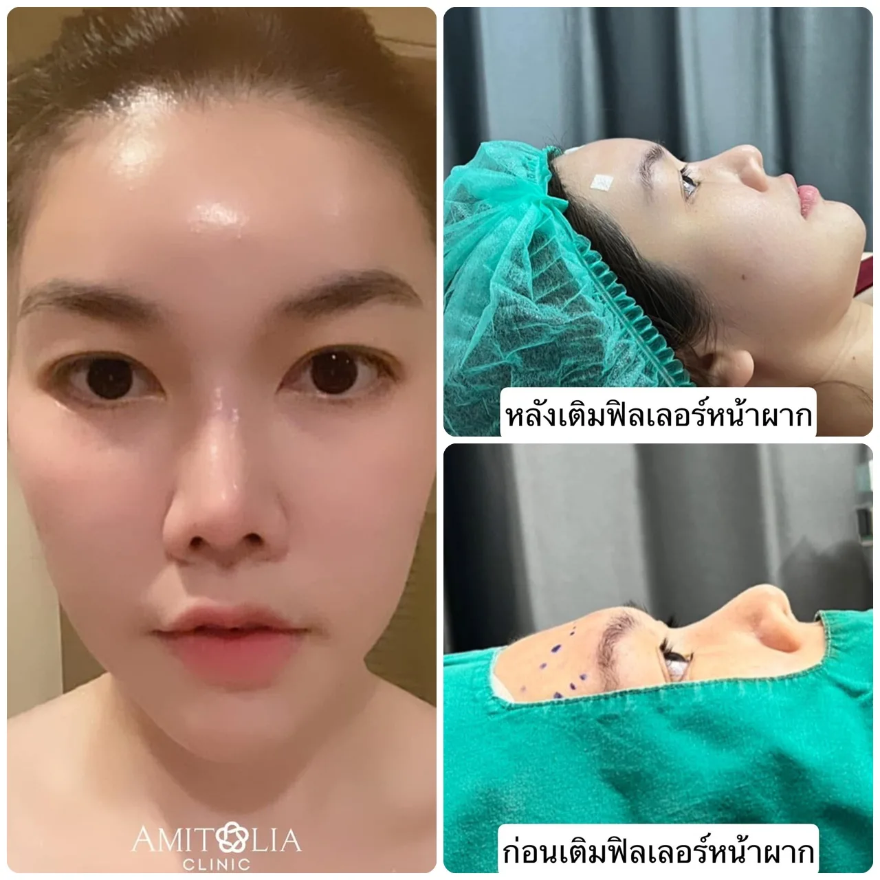 เติมฟิลเลอร์หน้าผากให้ละมุนมากขึ้น