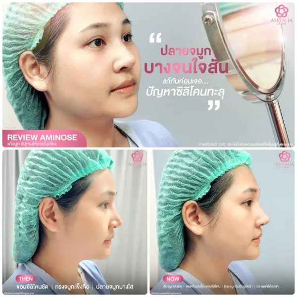 ปลายจมูกบาง