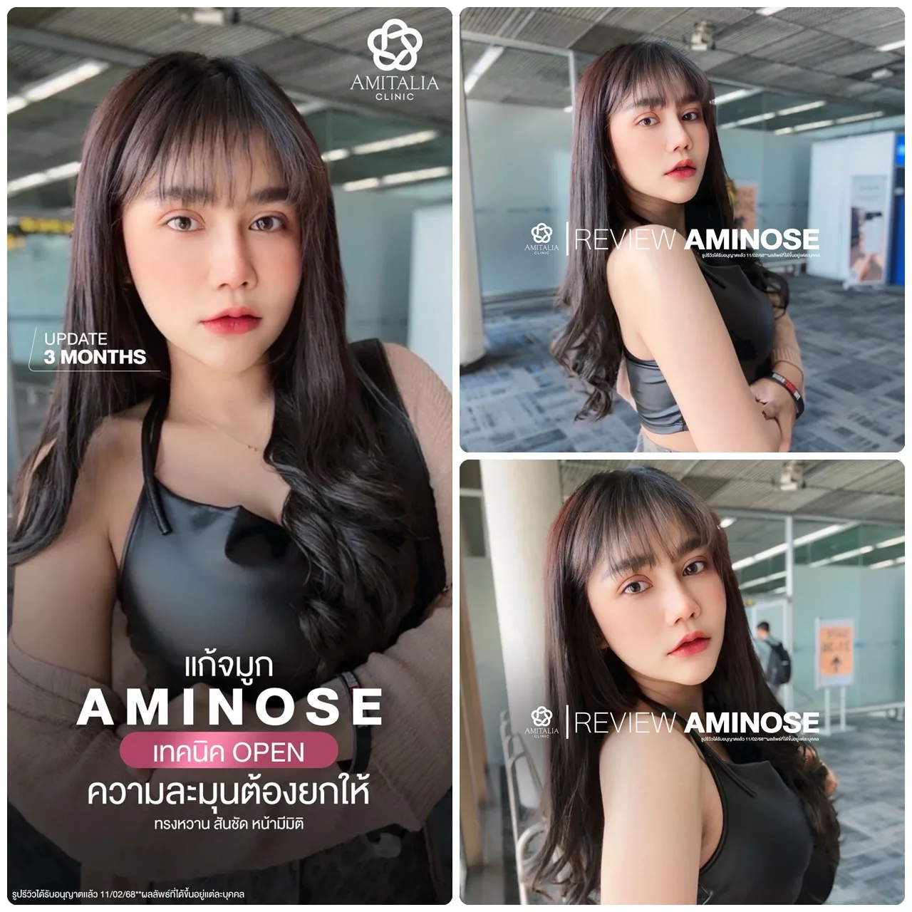 รีวิวเคสแก้จมูก Aminose เทคนิค Open สวยละมุน