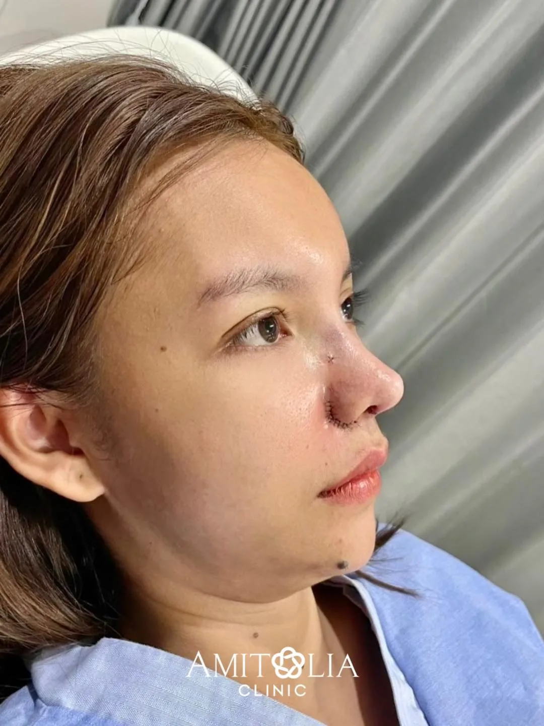 แก้จมูก + ตัดปีก ละมุนมาก