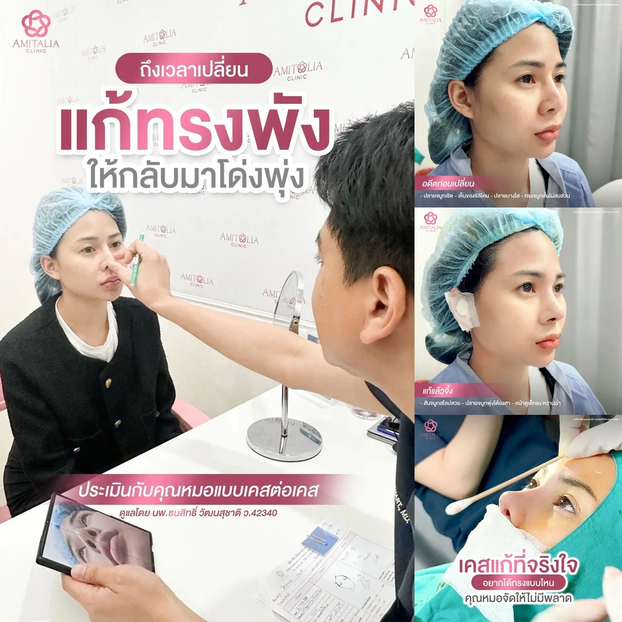 จมูกพัง ปัญหาที่คนเสริมจมูกไม่อยากเจอ…