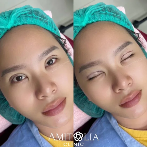 ตาสองชั้น