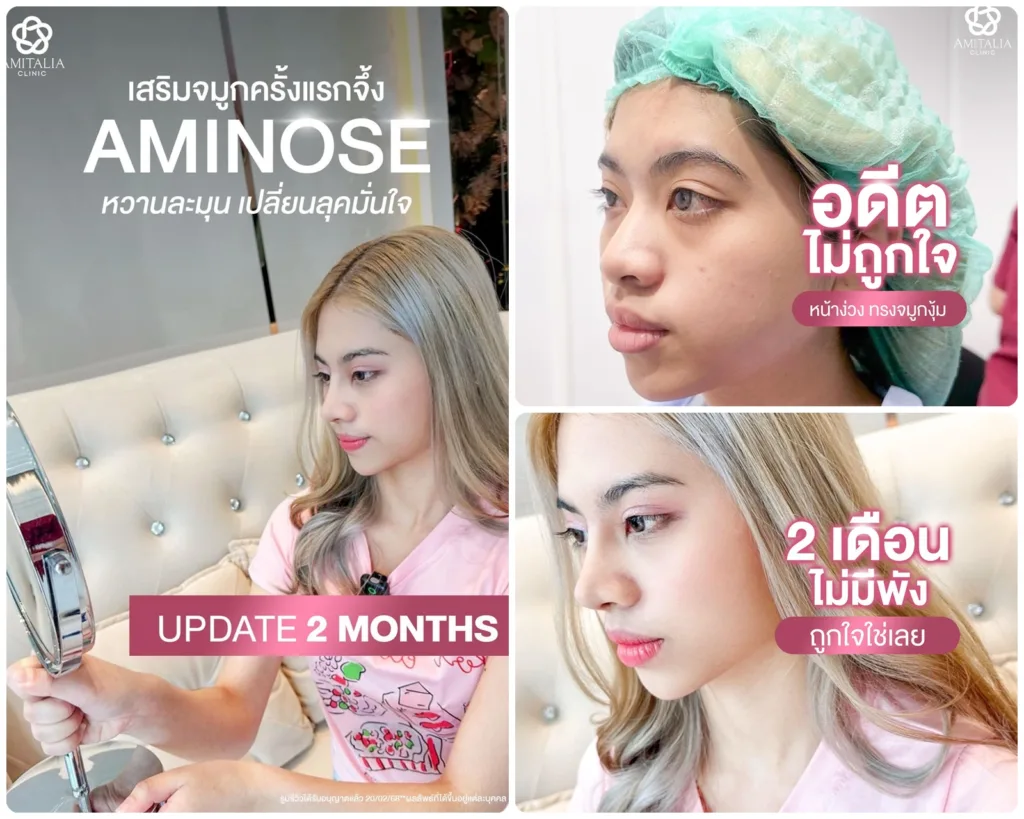 ทรงจมูก