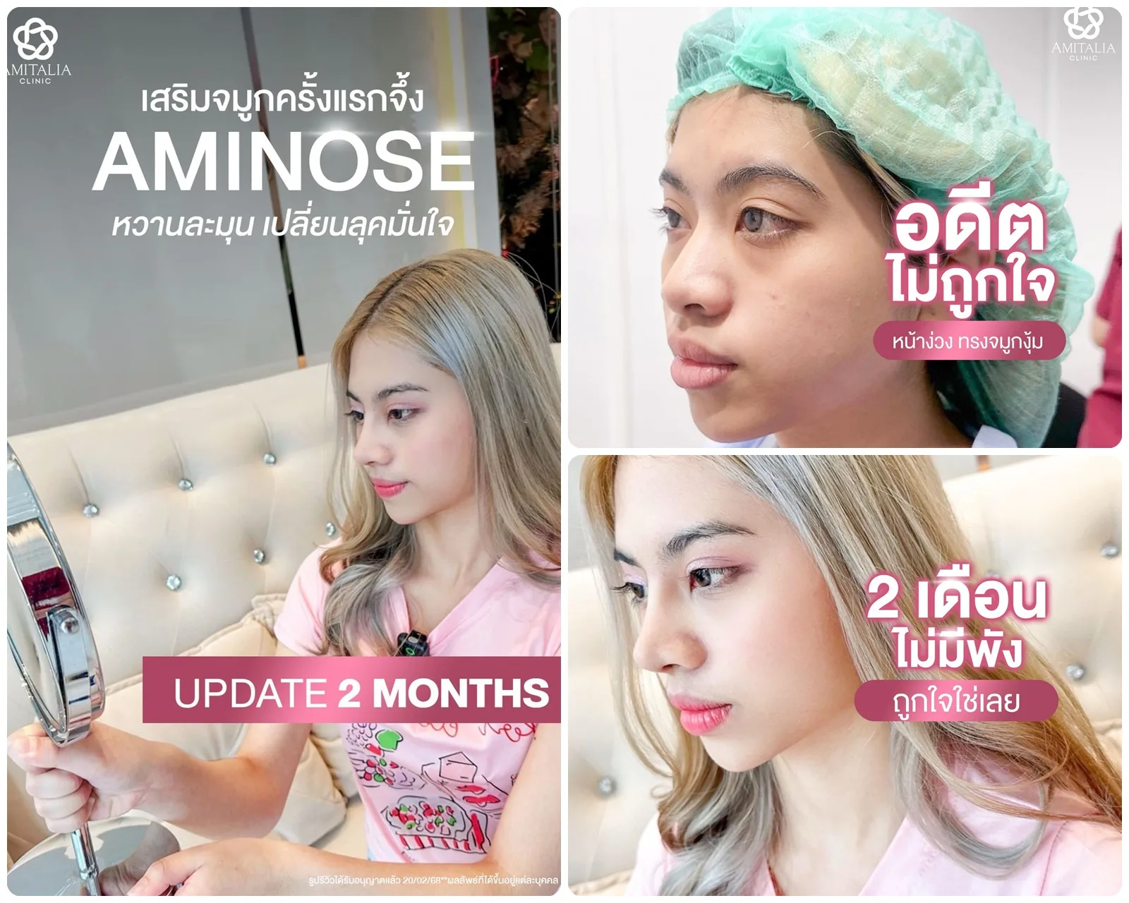 รีวิวอวดทรงจมูกอีกเเล้ว เสริมไปแล้วมั่นใจ