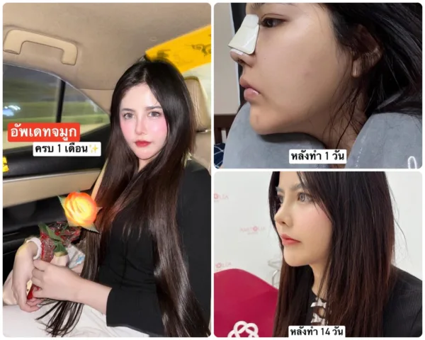 รีวิวแก้จมูก